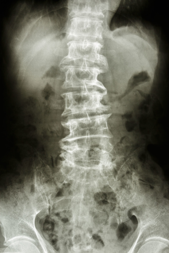 spinal-bone-spurs-back-pain-doctor-roseville-dr-stefano-sinicropi