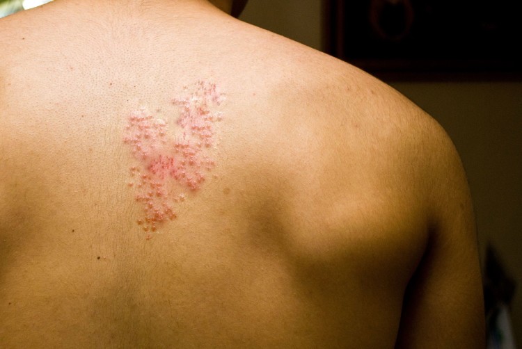 shingles-back-pain-surgery-dr-stefano-sinicropi-md