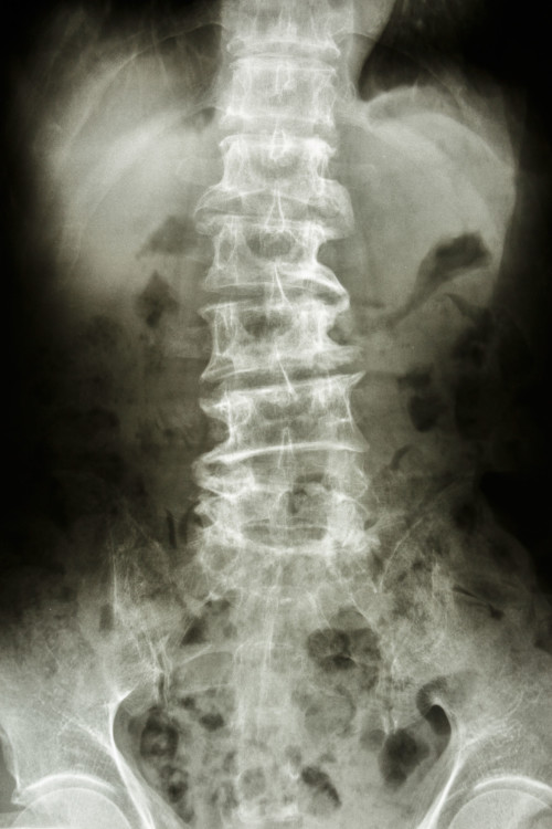 spinal-bone-spurs-back-pain-doctor-minneapolis-dr-stefano-sinicropi