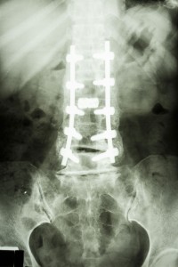 pedicle screws spine surgery