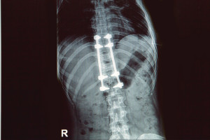 failed spine fusion