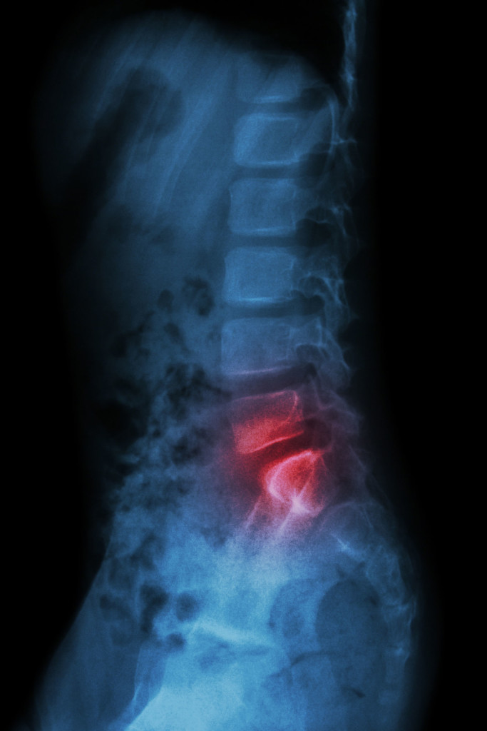 Lumbar Fracture Fixation - Lower Back - Surgery - What We Treat