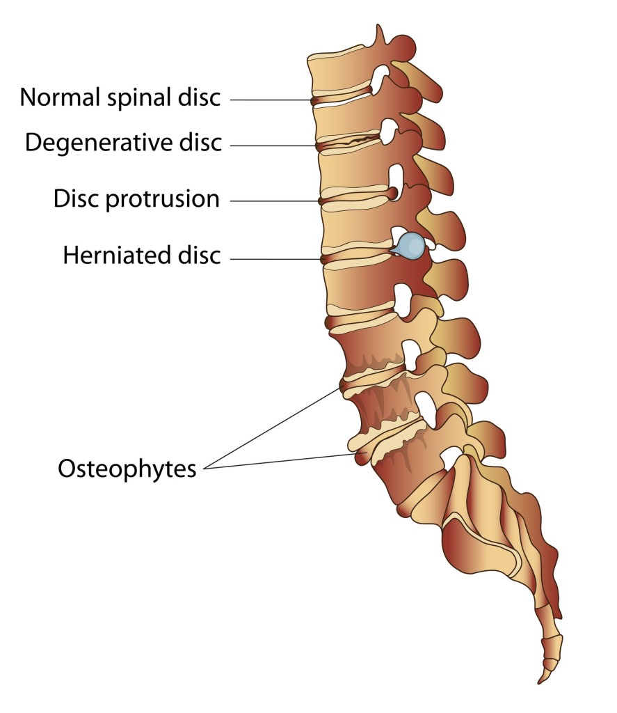 Lumbar Spine Degenerative Disc Diseases Treatment NJ & NYC