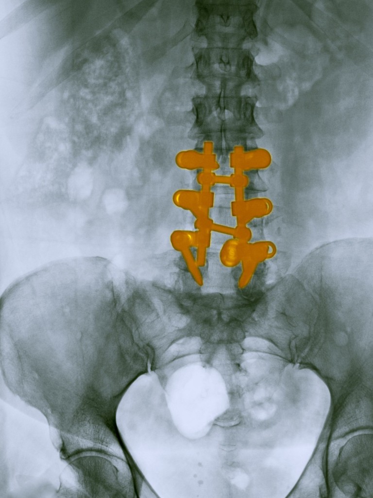 spinal hardware