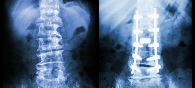 spine hardware