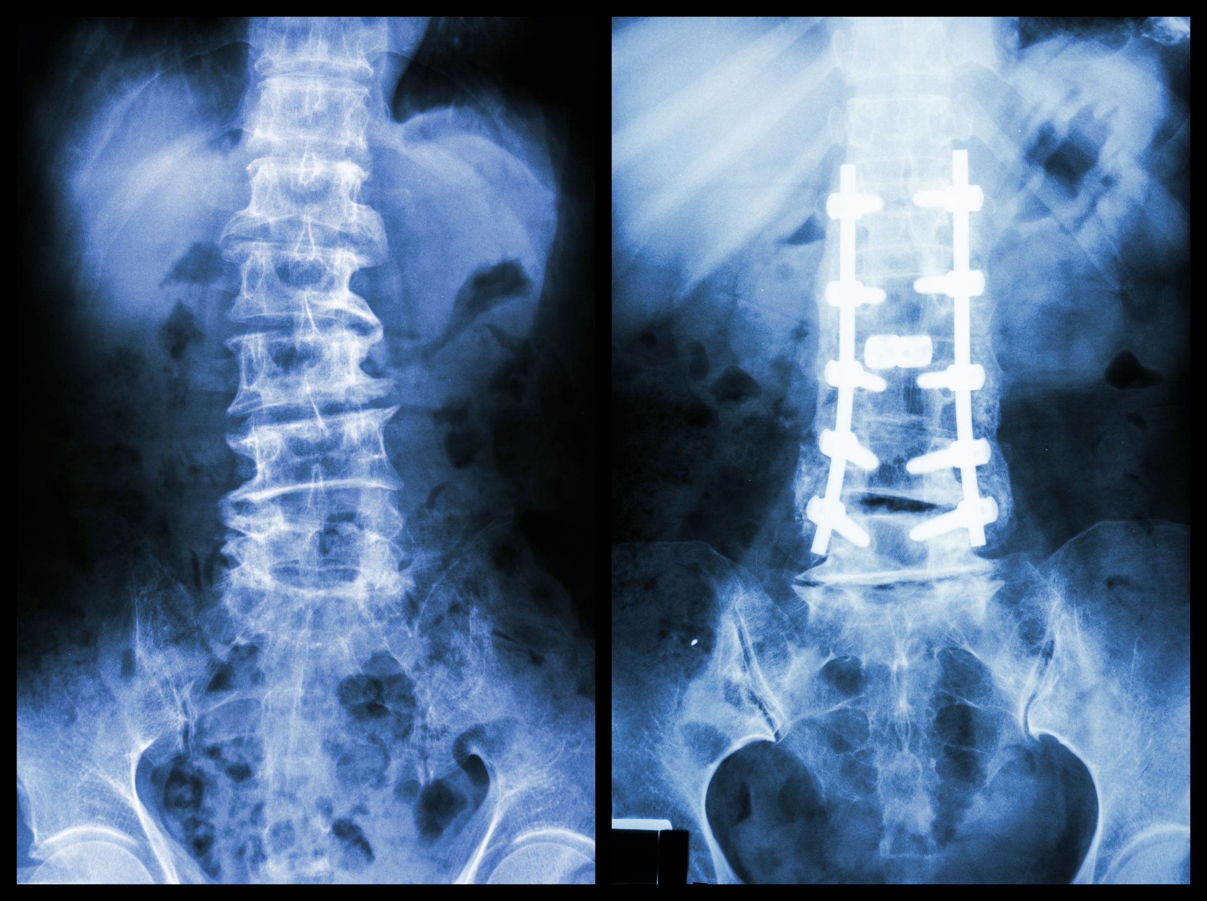 Lumbar Spine Surgery, How Much You Know?