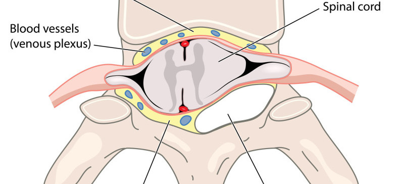 spinal abscess