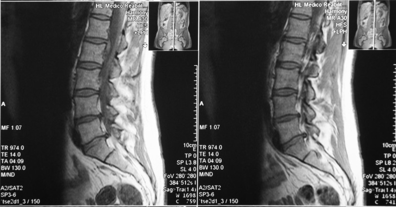 l2 l3 herniated disk xray images