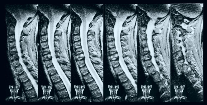 what-is-a-transverse-process-fracture-of-the-spine-apple-valley