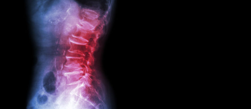 spinal x-ray vs mri vs ct scan