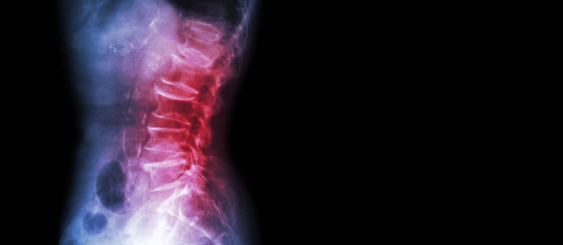 The Differences Between XRay, MRI & CT Scans For Spine Pain