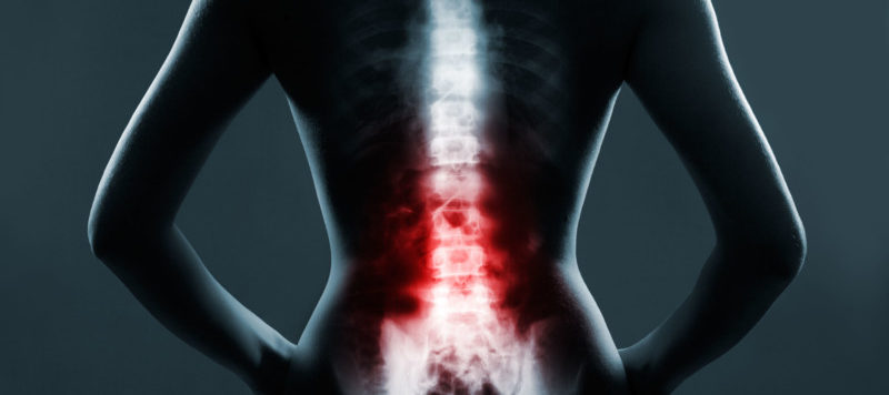 Spinal Arthritis Treatment Options