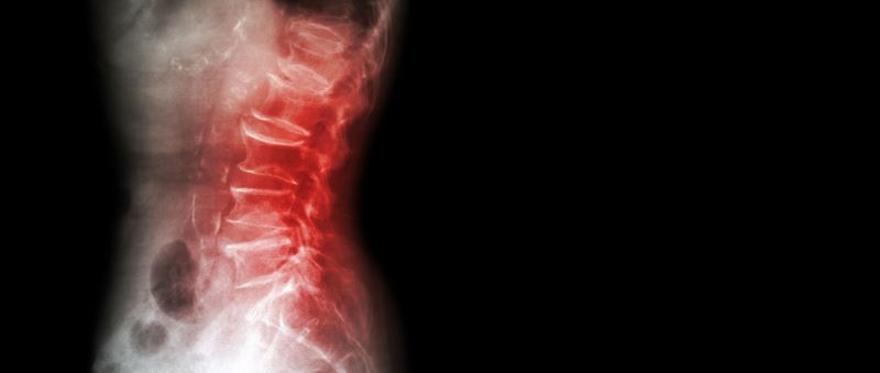 3 Signs Of An Infection At The Spinal Surgery Incision Site