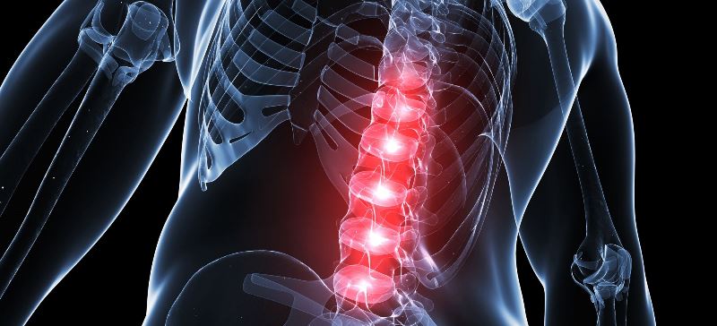 Shrinking Spinal Canal