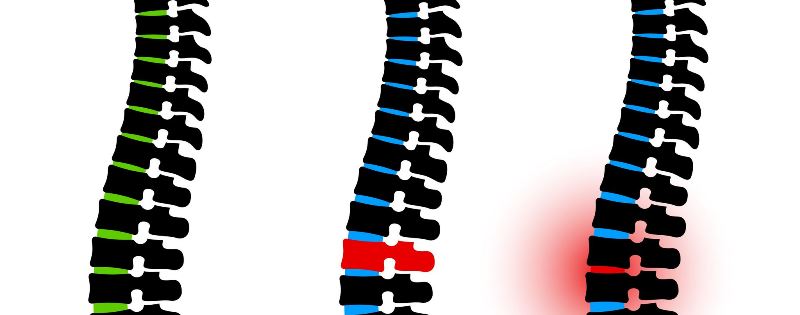 Perineural Cysts in the Spine