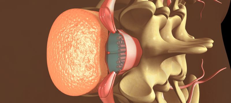 cerebrospinal fluid leak spine