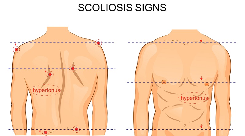 The Benefits & Potential Drawbacks of Scoliosis Surgery