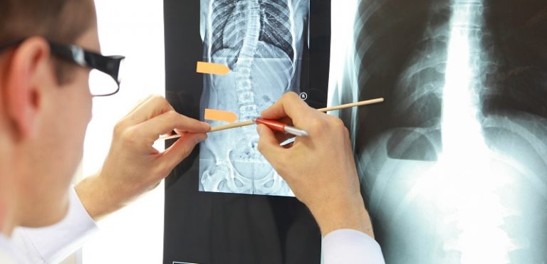 5 Common Causes of Scoliosis - Dr. Stefano Sinicropi, M.D.